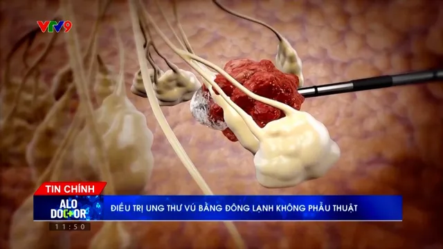 Alo Doctor (18/4/2026): Điều trị ung thư vú bằng đông lạnh không phẫu thuật
