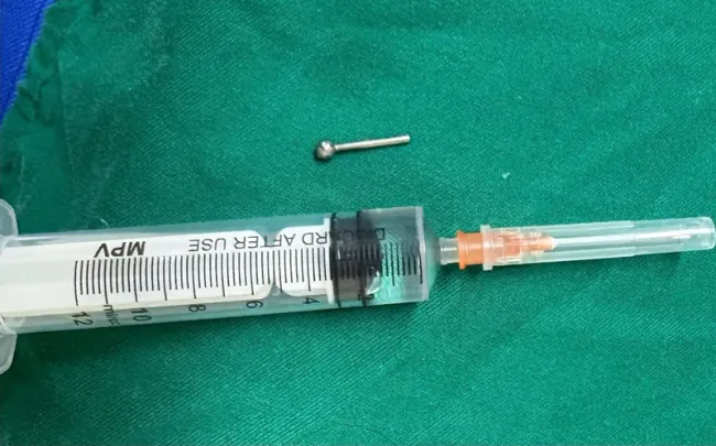Nhiều trường hợp nhập viện vì mắc dị vật tiêu hóa