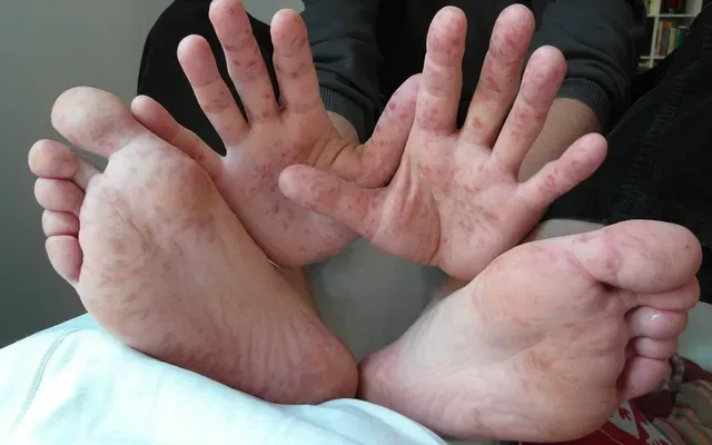 Gia tăng ca mắc tay chân miệng ở trẻ nhỏ: Cảnh báo từ môi trường học đường