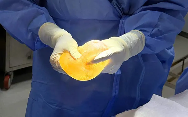 Gallery - A rare case of bilateral breast implants with different implant types | VTV - image 5