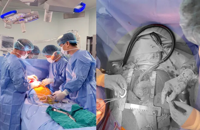 Image of the first CorHeart 6 implant surgery at Military Central Hospital 108 - Photo: Hospital provided.