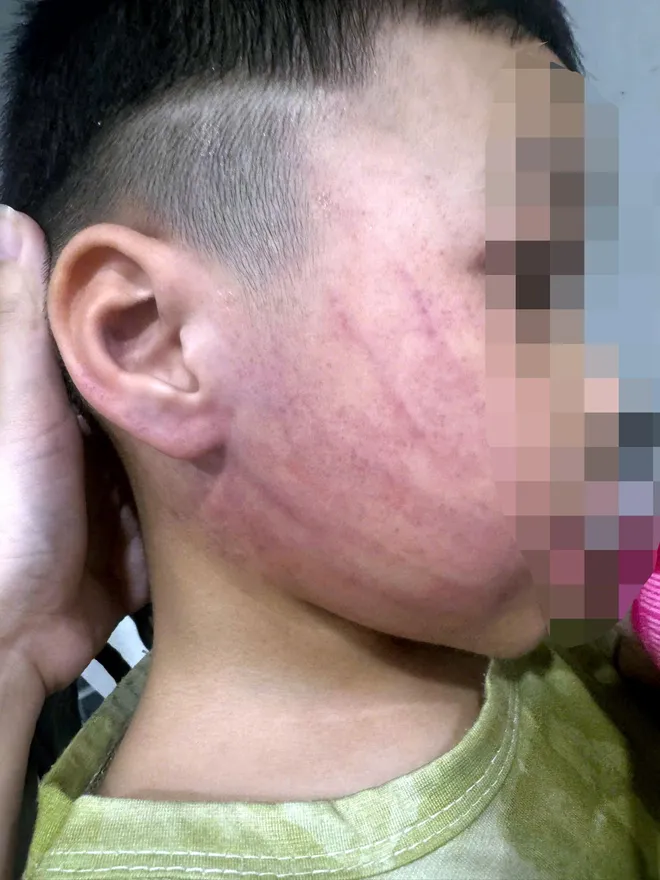 Bé 4 tuổi nghi bị giáo viên mầm non bạo hành, công an khẩn trương vào cuộc - Ảnh 2.
