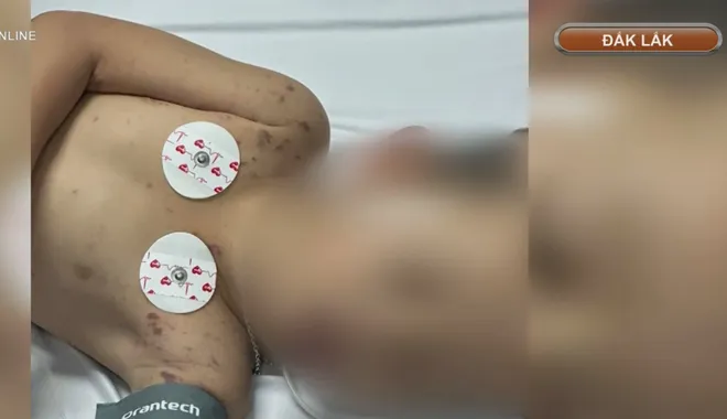 2 bệnh nh&acirc;n mắc vi&ecirc;m n&atilde;o m&ocirc; cầu ở Đắk Lắk, 1 trường hợp tử vong- Ảnh 2.