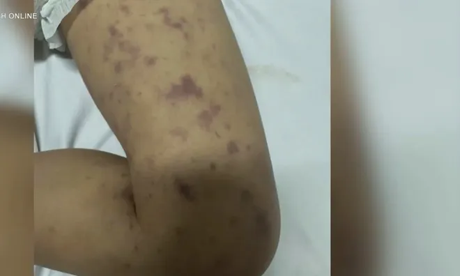 2 bệnh nh&acirc;n mắc vi&ecirc;m n&atilde;o m&ocirc; cầu ở Đắk Lắk, 1 trường hợp tử vong- Ảnh 1.