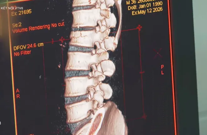 Kỹ thuật cao trong điều trị bệnh l&yacute; cột sống- Ảnh 6.