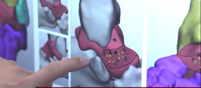 Kỳ tích y khoa: Thay xương sên bằng công nghệ in 3D cứu thanh niên khỏi nguy cơ tàn phế- Ảnh 2. Kỳ tích y khoa: Thay xương sên bằng công nghệ in 3D cứu thanh niên khỏi nguy cơ tàn phế- Ảnh 2.