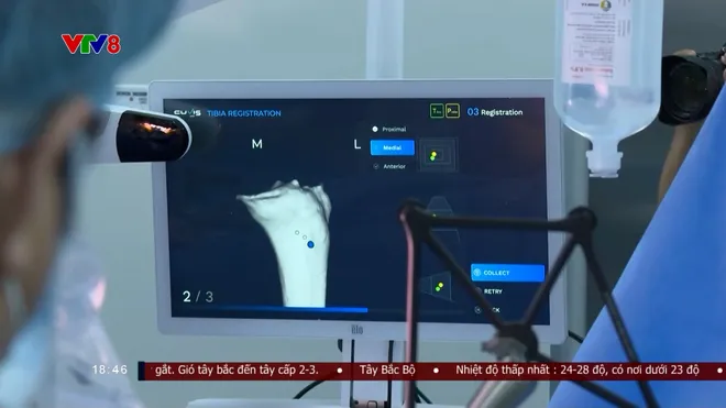 Hơn 100 ca thay khớp phức tạp được thực hiện thành công nhờ Robot AI- Ảnh 3. Hơn 100 ca thay khớp phức tạp được thực hiện thành công nhờ Robot AI- Ảnh 3.