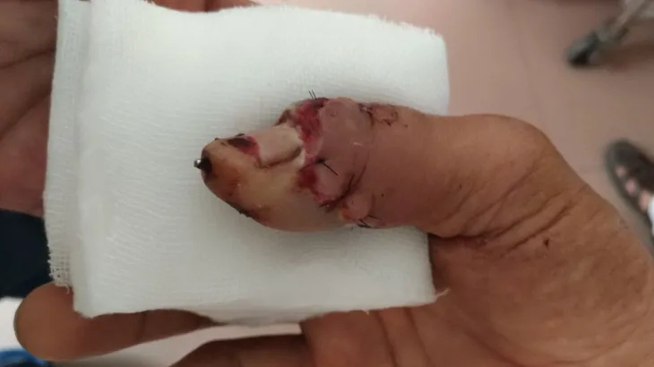 Người đàn ông vào viện với đốt ngón tay đứt rời, vết thương nham nhở - Ảnh 1. Người đàn ông vào viện với đốt ngón tay đứt rời, vết thương nham nhở - Ảnh 1.