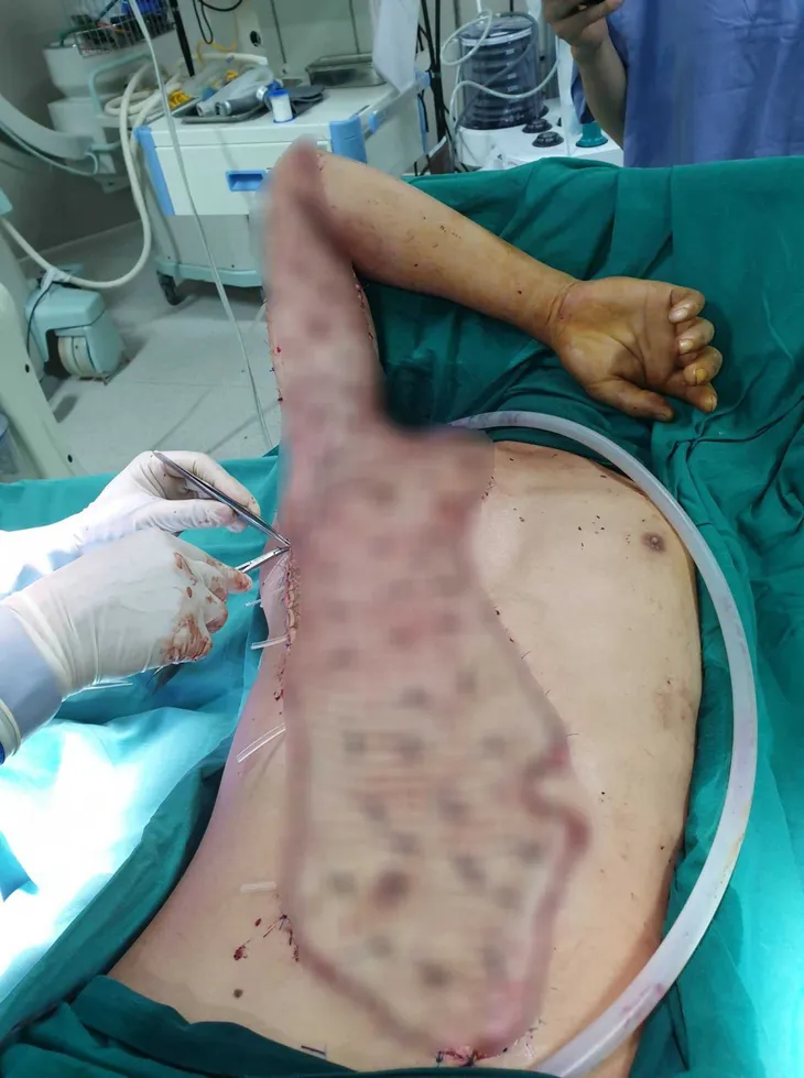 Nam thanh niên bị máy bóc vỏ gỗ lột toàn bộ da cánh tay - Ảnh 3. Nam thanh niên bị máy bóc vỏ gỗ lột toàn bộ da cánh tay - Ảnh 3.