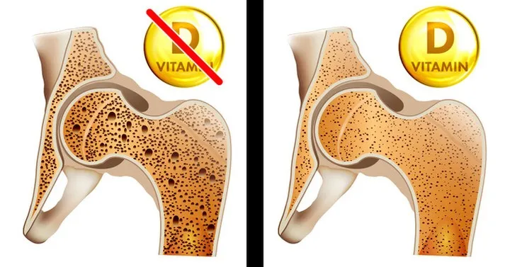 8 dấu hiệu chứng tỏ bạn cần bổ sung vitamin D - Ảnh 2. 8 dấu hiệu chứng tỏ bạn cần bổ sung vitamin D - Ảnh 2.