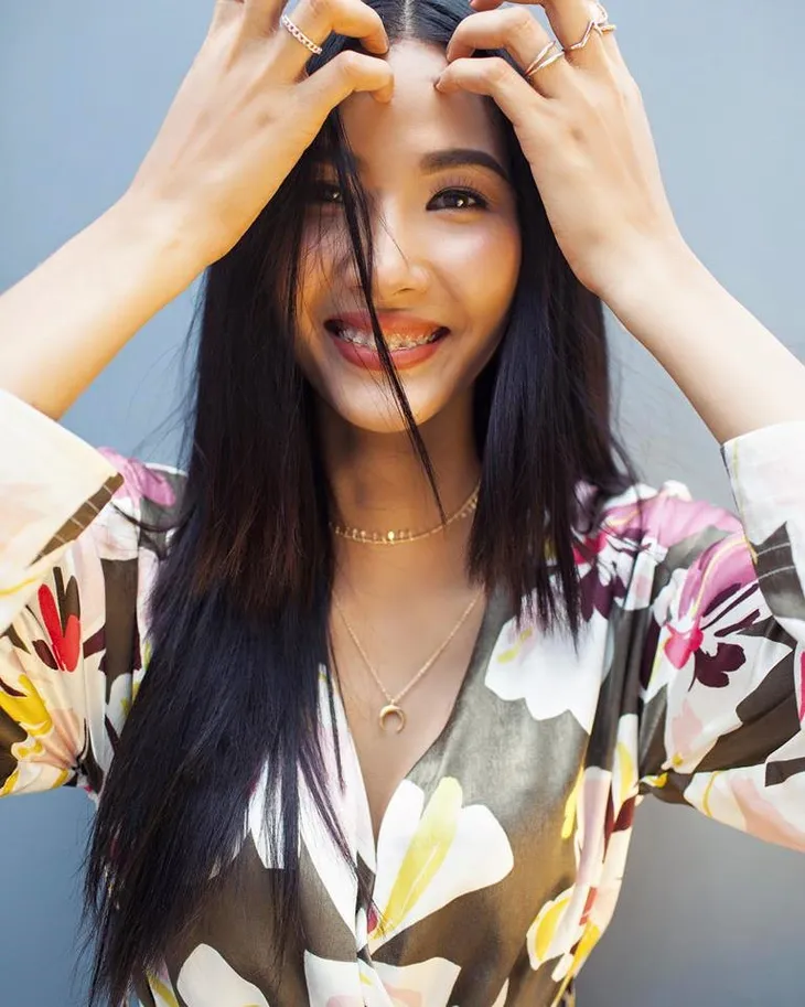 Á hậu Hoàng Thùy niềng răng thay đổi ngoại hình - Ảnh 1. Á hậu Hoàng Thùy niềng răng thay đổi ngoại hình - Ảnh 1.