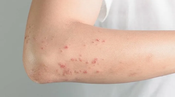 9 tác dụng phụ nguy hiểm của dầu bạc hà - Ảnh 2. 9 tác dụng phụ nguy hiểm của dầu bạc hà - Ảnh 2.