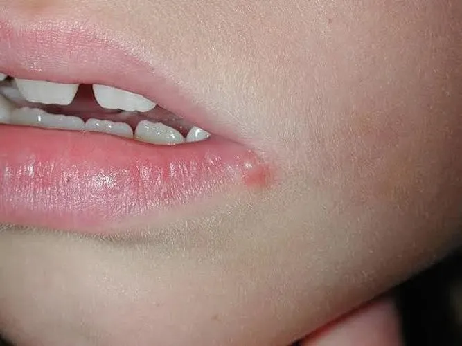 9 tác dụng phụ nguy hiểm của dầu bạc hà - Ảnh 6. 9 tác dụng phụ nguy hiểm của dầu bạc hà - Ảnh 6.
