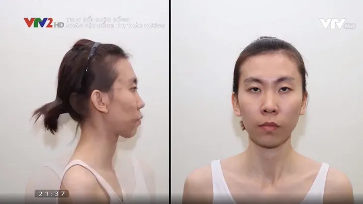Nữ nhà báo 9X thay đổi khác lạ sau phẫu thuật thẩm mỹ - Ảnh 1. Nữ nhà báo 9X thay đổi khác lạ sau phẫu thuật thẩm mỹ - Ảnh 1.