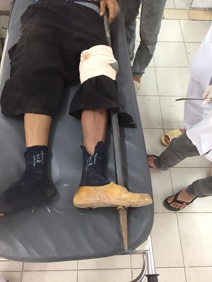 Hà Nội: Thợ hồ bị xà beng đâm thủng bàn chân - Ảnh 1. Hà Nội: Thợ hồ bị xà beng đâm thủng bàn chân - Ảnh 1.