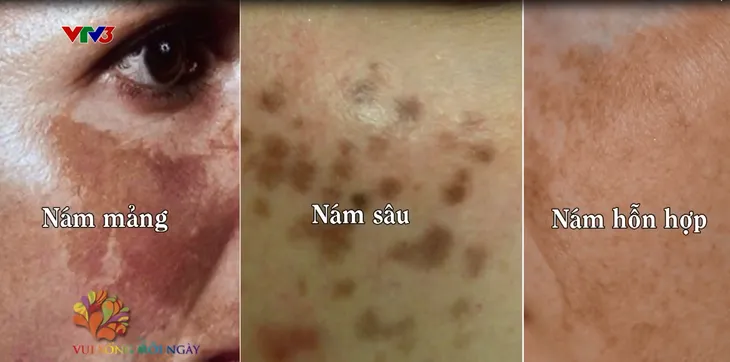 Ngăn chặn tình trạng nám da ở tuổi 30 - Ảnh 1. Ngăn chặn tình trạng nám da ở tuổi 30 - Ảnh 1.