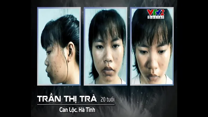Change Life 2018: Cô sinh viên trường y tự tin sau phẫu thuật thẩm mĩ - Ảnh 1. Change Life 2018: Cô sinh viên trường y tự tin sau phẫu thuật thẩm mĩ - Ảnh 1.