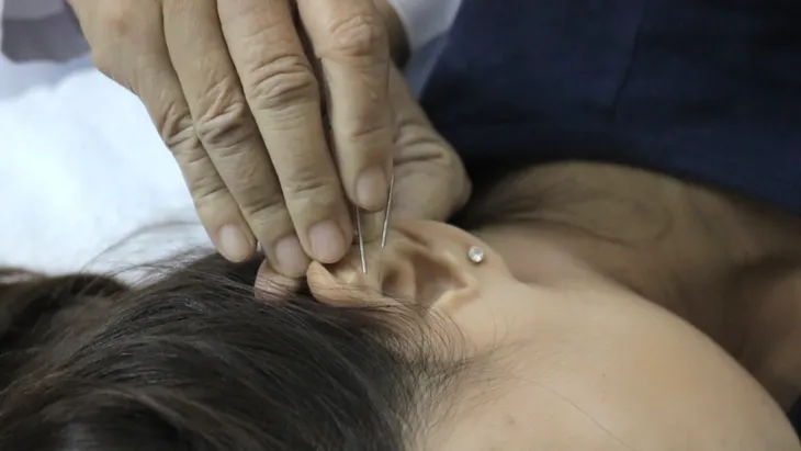 Châm cứu - Phương pháp hiệu quả trong điều trị rối loạn giấc ngủ - Ảnh 1. Châm cứu - Phương pháp hiệu quả trong điều trị rối loạn giấc ngủ - Ảnh 1.