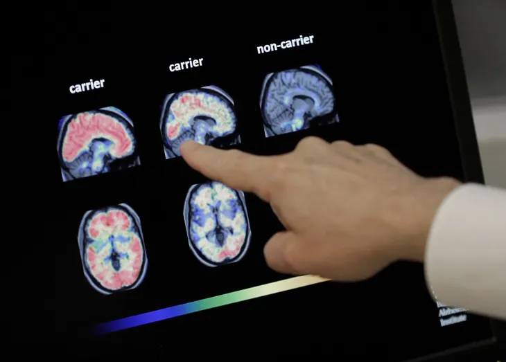 Loại thuốc đầu tiên có thể làm chậm bệnh Alzheimer - Ảnh 1. Loại thuốc đầu tiên có thể làm chậm bệnh Alzheimer - Ảnh 1.