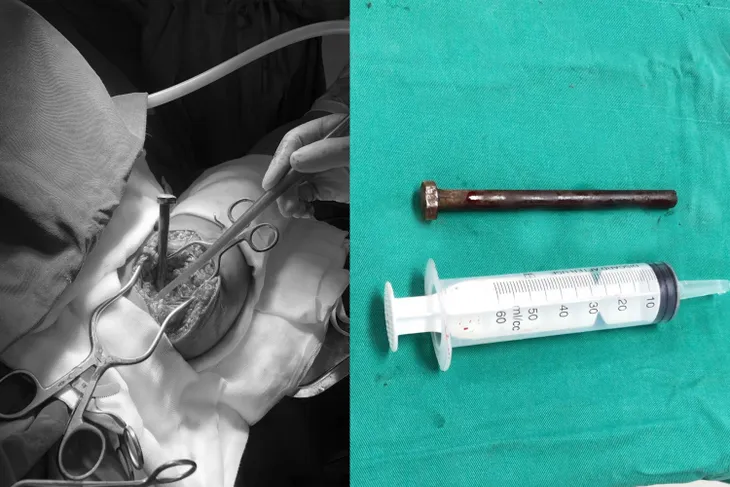 Ngã từ tầng hai, người đàn ông bị đinh sắt dài 20cm găm vào vai - Ảnh 1. Ngã từ tầng hai, người đàn ông bị đinh sắt dài 20cm găm vào vai - Ảnh 1.