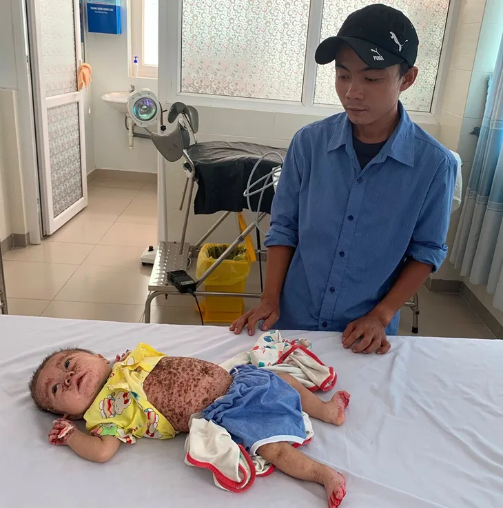 Xót xa bé 5 tháng tuổi bị viêm da tiết bã bội nhiễm nặng - Ảnh 1. Xót xa bé 5 tháng tuổi bị viêm da tiết bã bội nhiễm nặng - Ảnh 1.