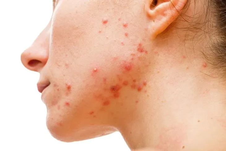10 nguy cơ không ngờ từ dầu dừa - Ảnh 3.