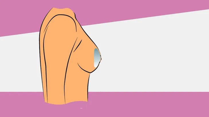 Pháp cấm một loại túi nâng ngực liên quan đến dạng ung thư hiếm gặp - Ảnh 1.