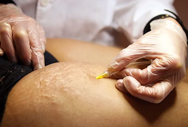 Nguyên nhân gây rạn da và cách khắc phục - Ảnh 6. Nguyên nhân gây rạn da và cách khắc phục - Ảnh 6.