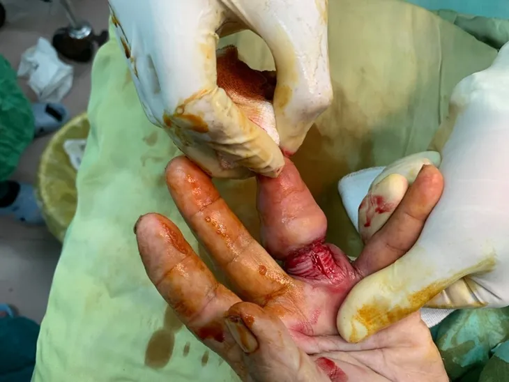 Cứu ngón tay đeo nhẫn suýt hoại tử của một cụ bà - Ảnh 2. Cứu ngón tay đeo nhẫn suýt hoại tử của một cụ bà - Ảnh 2.