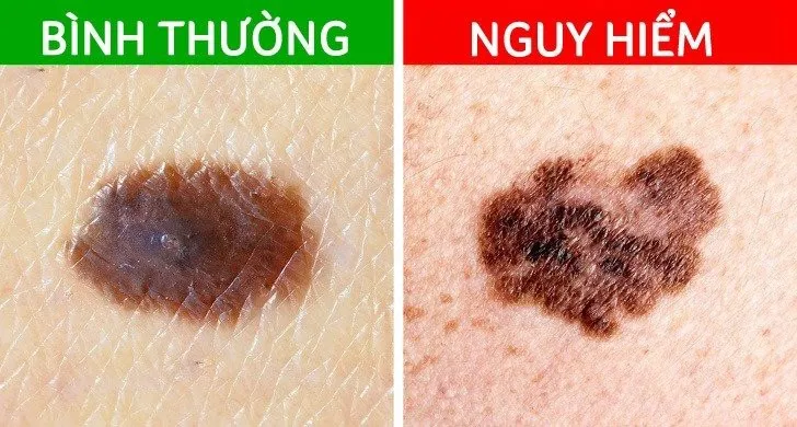 5 tín hiệu từ nốt ruồi cảnh báo ung thư đang tiềm ẩn - Ảnh 2.