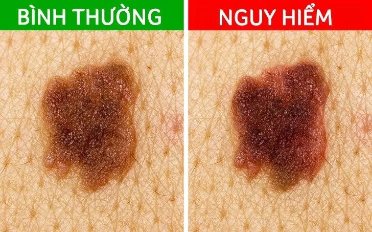 5 tín hiệu từ nốt ruồi cảnh báo ung thư đang tiềm ẩn - Ảnh 3.