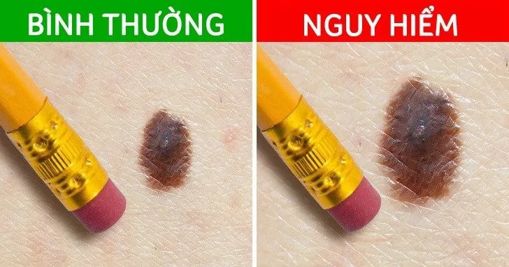 5 tín hiệu từ nốt ruồi cảnh báo ung thư đang tiềm ẩn - Ảnh 4.