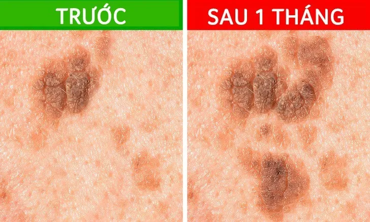 5 tín hiệu từ nốt ruồi cảnh báo ung thư đang tiềm ẩn - Ảnh 5.