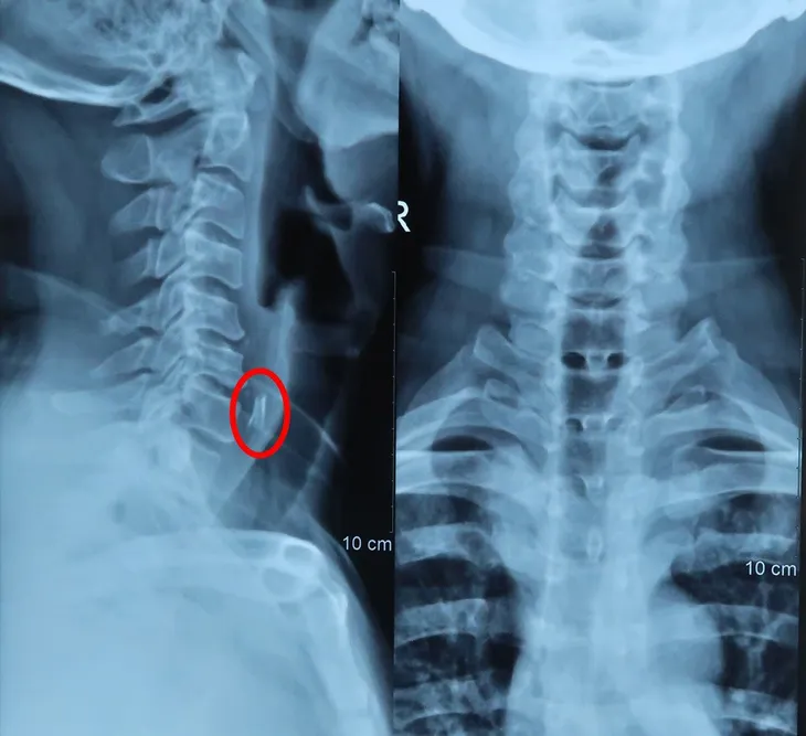 Nuốt vội miếng xương gà vì sợ lỡ chuyến phà, người đàn ông suýt chết - Ảnh 1.