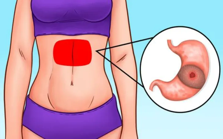 Vị trí đau bụng tiết lộ gì về sức khỏe của bạn? - Ảnh 3. Vị trí đau bụng tiết lộ gì về sức khỏe của bạn? - Ảnh 3.