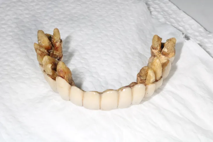Chọn phương pháp trồng răng giả giá rẻ có an toàn hay không? - Ảnh 1. Chọn phương pháp trồng răng giả giá rẻ có an toàn hay không? - Ảnh 1.