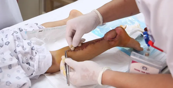 Bé 10 tuổi bị nan hoa xe đạp bào hết vạt da vùng gót chân - Ảnh 1. Bé 10 tuổi bị nan hoa xe đạp bào hết vạt da vùng gót chân - Ảnh 1.