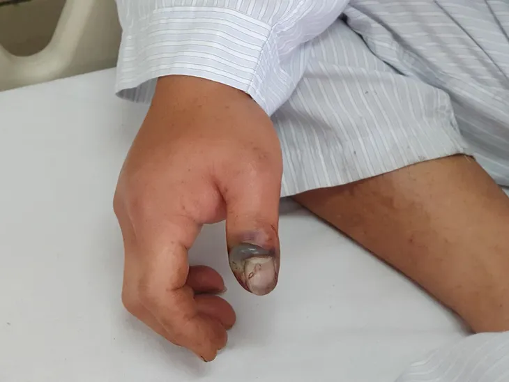 Trung tâm Chống độc Bệnh viện Bạch Mai tiếp nhận nhiều ca bị rắn độc cắn - Ảnh 1. Trung tâm Chống độc Bệnh viện Bạch Mai tiếp nhận nhiều ca bị rắn độc cắn - Ảnh 1.