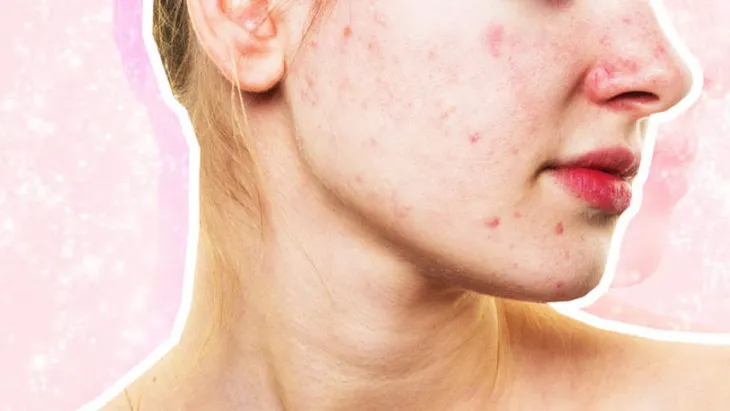 Tiết lộ phương pháp trị mụn viêm nấm bằng dầu gội - Ảnh 1. Tiết lộ phương pháp trị mụn viêm nấm bằng dầu gội - Ảnh 1.