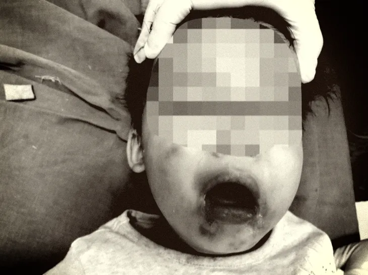 Cắn dây điện, bé gái 2 tuổi bị bỏng nặng vùng miệng - Ảnh 1. Cắn dây điện, bé gái 2 tuổi bị bỏng nặng vùng miệng - Ảnh 1.