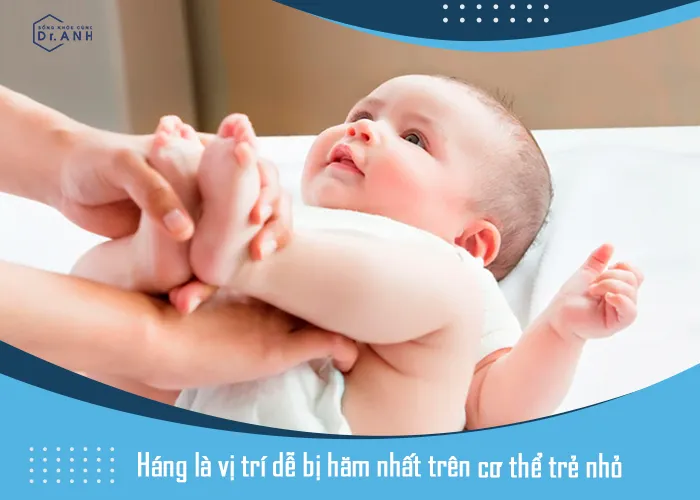 Bỏ túi mẹo trị hăm siêu đơn giản dành cho bé yêu - Ảnh 1. Bỏ túi mẹo trị hăm siêu đơn giản dành cho bé yêu - Ảnh 1.