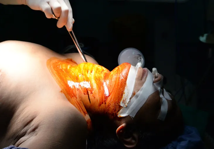 Cắt bướu giáp khổng lồ thòng trung thất 30 năm cho người phụ nữ ở Điện Biên - Ảnh 2. Cắt bướu giáp khổng lồ thòng trung thất 30 năm cho người phụ nữ ở Điện Biên - Ảnh 2.
