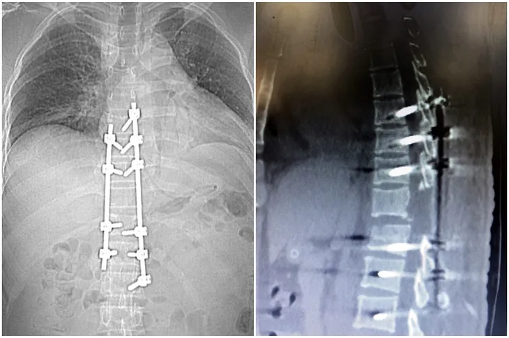 Ngã từ độ cao 5m, người đàn ông đàn ông dập nát đốt sống ngực - Ảnh 1. Ngã từ độ cao 5m, người đàn ông đàn ông dập nát đốt sống ngực - Ảnh 1.