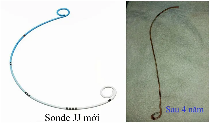 Sỏi to như quả trứng gà tích tụ quanh ống sonde JJ bỏ quên suốt... 4 năm trong bụng - Ảnh 1. Sỏi to như quả trứng gà tích tụ quanh ống sonde JJ bỏ quên suốt... 4 năm trong bụng - Ảnh 1.