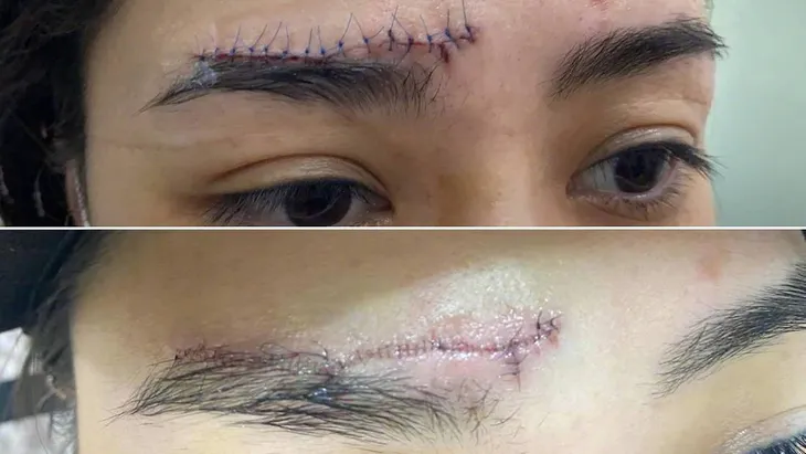 Chung Hân Đồng khoe vết sẹo dài ngoằng trên trán, khán giả e ngại - Ảnh 1. Chung Hân Đồng khoe vết sẹo dài ngoằng trên trán, khán giả e ngại - Ảnh 1.