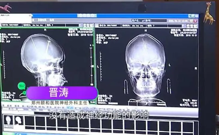 Sốc khi phát hiện 2 chiếc kim châm cứu găm sâu trong não bệnh nhân - Ảnh 1.