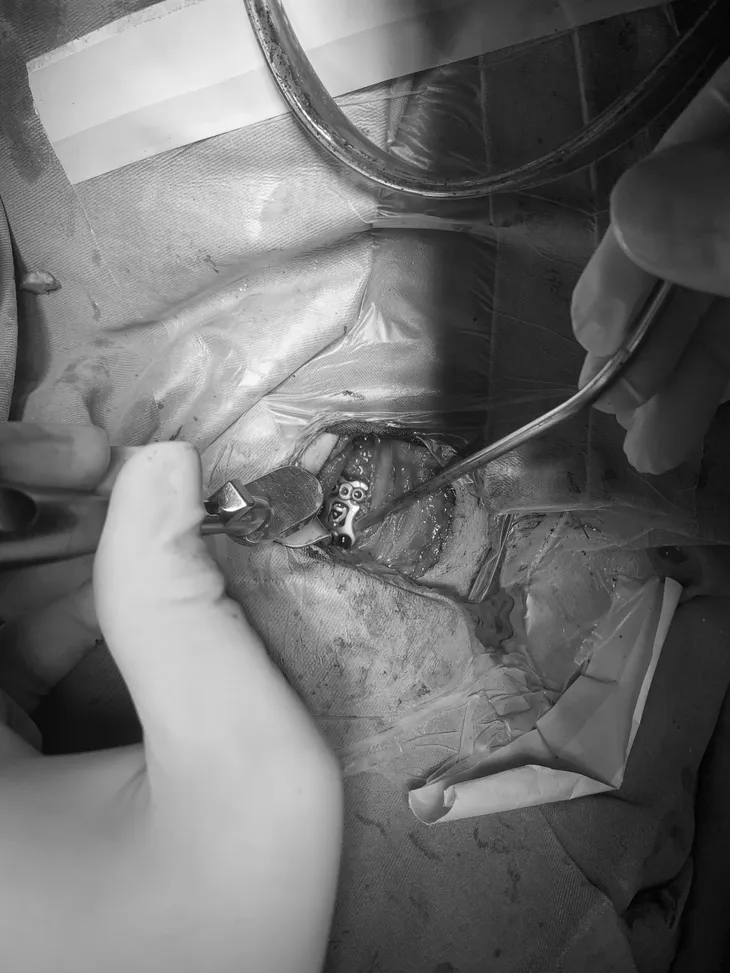 Người đàn ông thoát liệt sau ca phẫu thuật điều trị ung thư tiền liệt tuyến di căn cột sống cổ - Ảnh 1. Người đàn ông thoát liệt sau ca phẫu thuật điều trị ung thư tiền liệt tuyến di căn cột sống cổ - Ảnh 1.