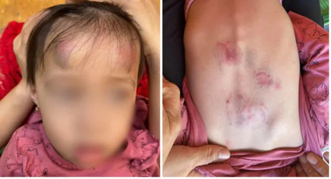 Bé gái mầm non bị bạn đánh, đạp thâm tím tại lớp, cô giáo không biết - Ảnh 1. Bé gái mầm non bị bạn đánh, đạp thâm tím tại lớp, cô giáo không biết - Ảnh 1.