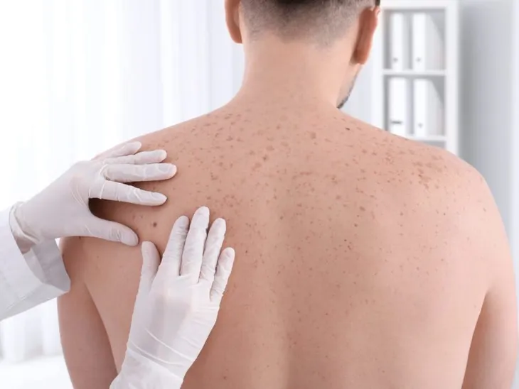Những triệu chứng ung thư da không thể bỏ qua - Ảnh 1. Những triệu chứng ung thư da không thể bỏ qua - Ảnh 1.