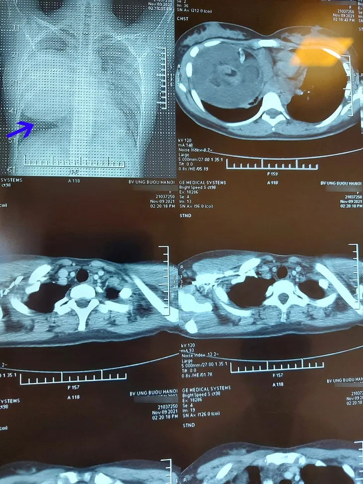 Đi khám vì tức ngực, khó thở, cô gái trẻ phát hiện khối u quái hơn 20cm trong lồng ngực - Ảnh 1. Đi khám vì tức ngực, khó thở, cô gái trẻ phát hiện khối u quái hơn 20cm trong lồng ngực - Ảnh 1.